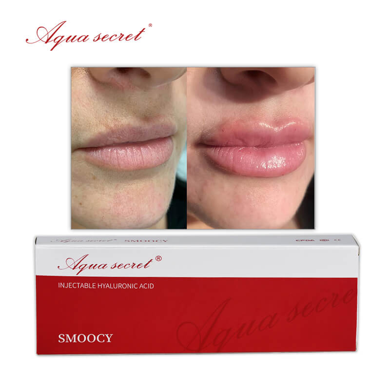cuanto dura el relleno de labios con acido hialuronico