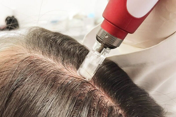 mesoterapia capilar precios