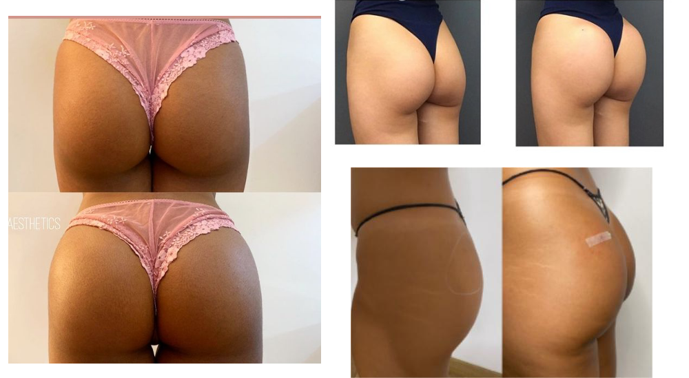 precio de acido hialuronico para gluteos