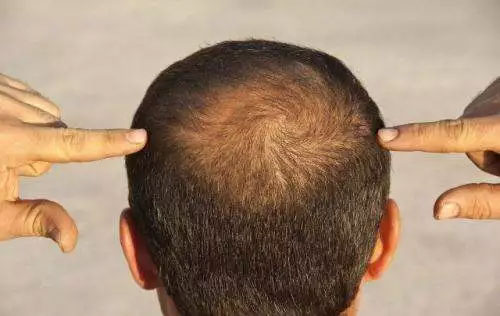 exosomas para caida de cabello