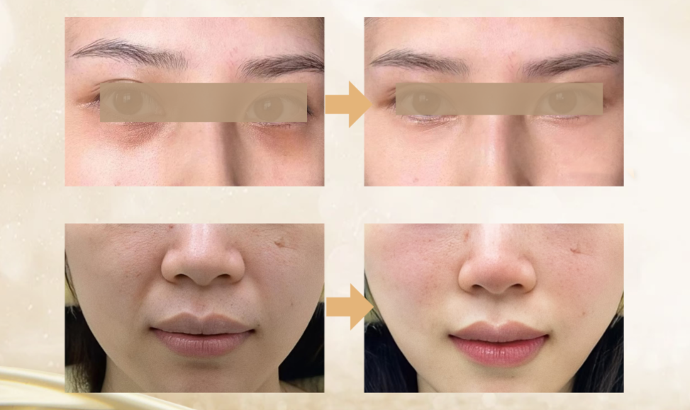 Implante de Colágeno