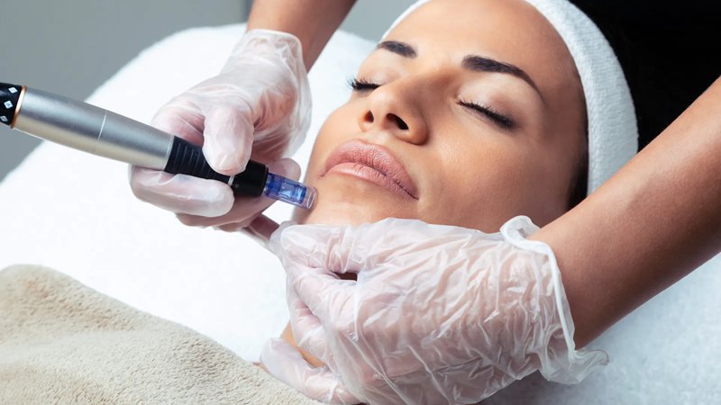 Efectos secundarios del microneedling con exosomas