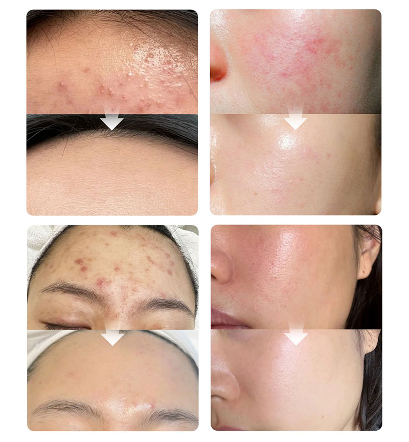 exosomas + pdrn de salmon