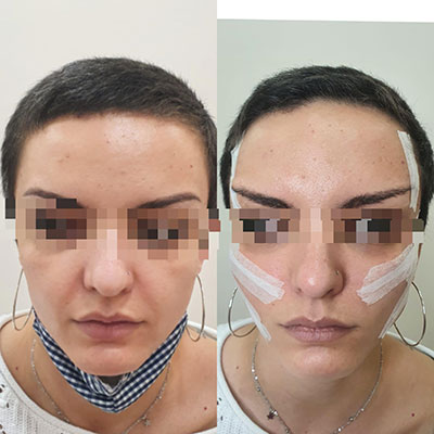 Levantamiento de Cejas con PDO