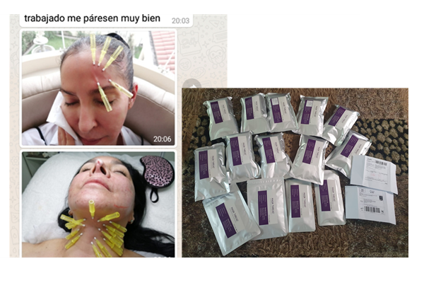 hilos de sustentacion facial pdo