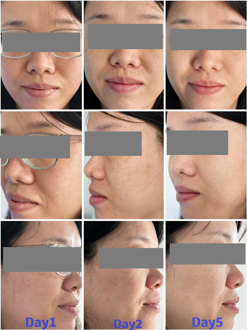 Mesoterapia Antes y Despu&eacute;s