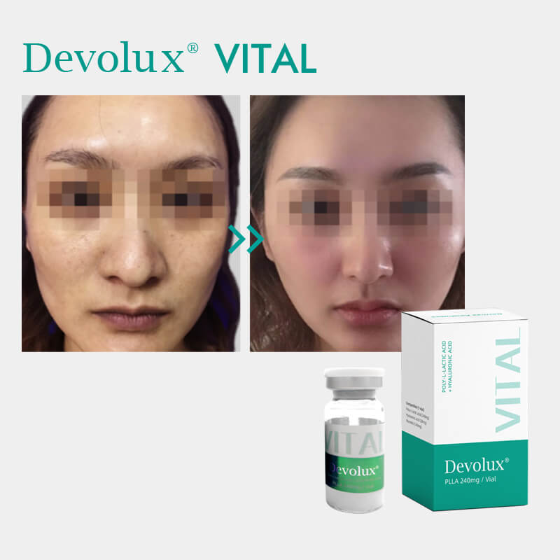 Devolux® Vital 240 Mg Ácido Poliláctico Precio