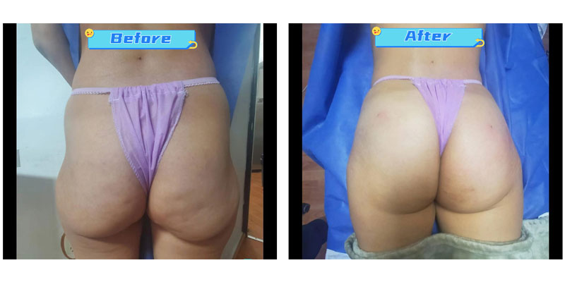 Butt Injections Before and After patients 4.jpg