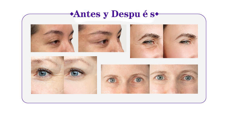 Monofilamentos Magik Thread&reg; PDO Antes y Despu&eacute;s (2)