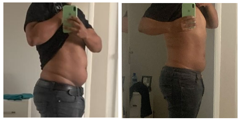 Inyecciones para quemar grasa abdominal