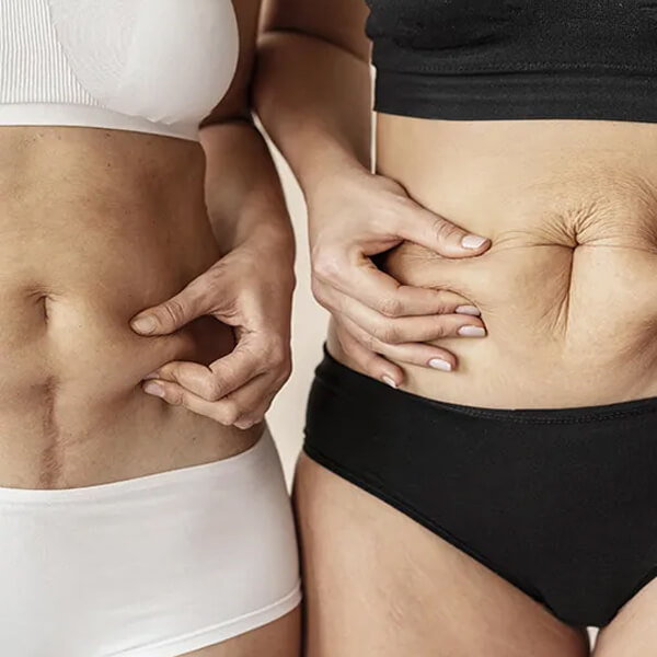 Aplicación Del Ácido Poliláctico En Flacidez Corporal