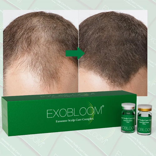 Mesoterapia Capilar, ¿Qué Es Y Cuál Es Su Precio?