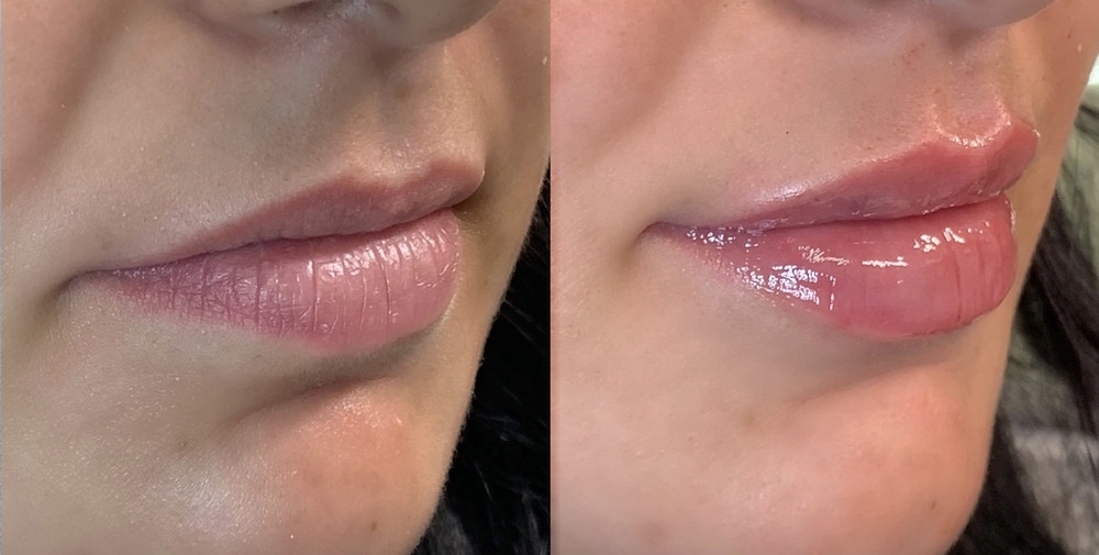 &aacute;cido hialur&oacute;nico para relleno de labios