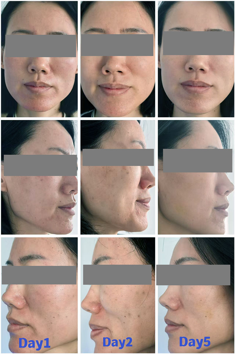 Mesoterapia Antes y Despu&eacute;s