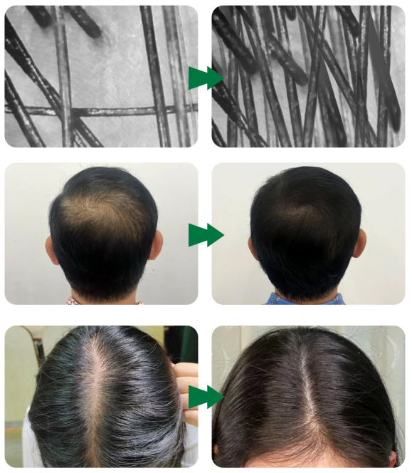 tratamiento con exosomas capilares