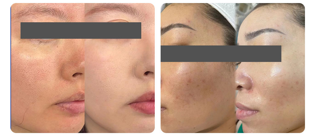 exosomas para rejuvenecimiento facial