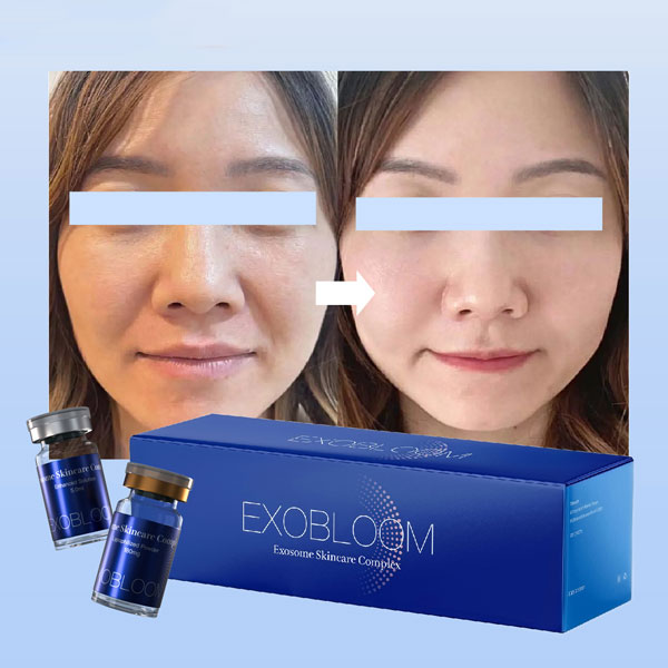 Tratamiento Facial Con Exosomas: Antes Y Después – Resultados Reales