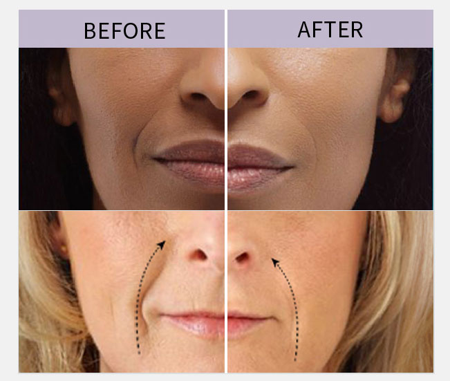 inyecciones de &aacute;cido hialur&oacute;nico en surco nasogeniano