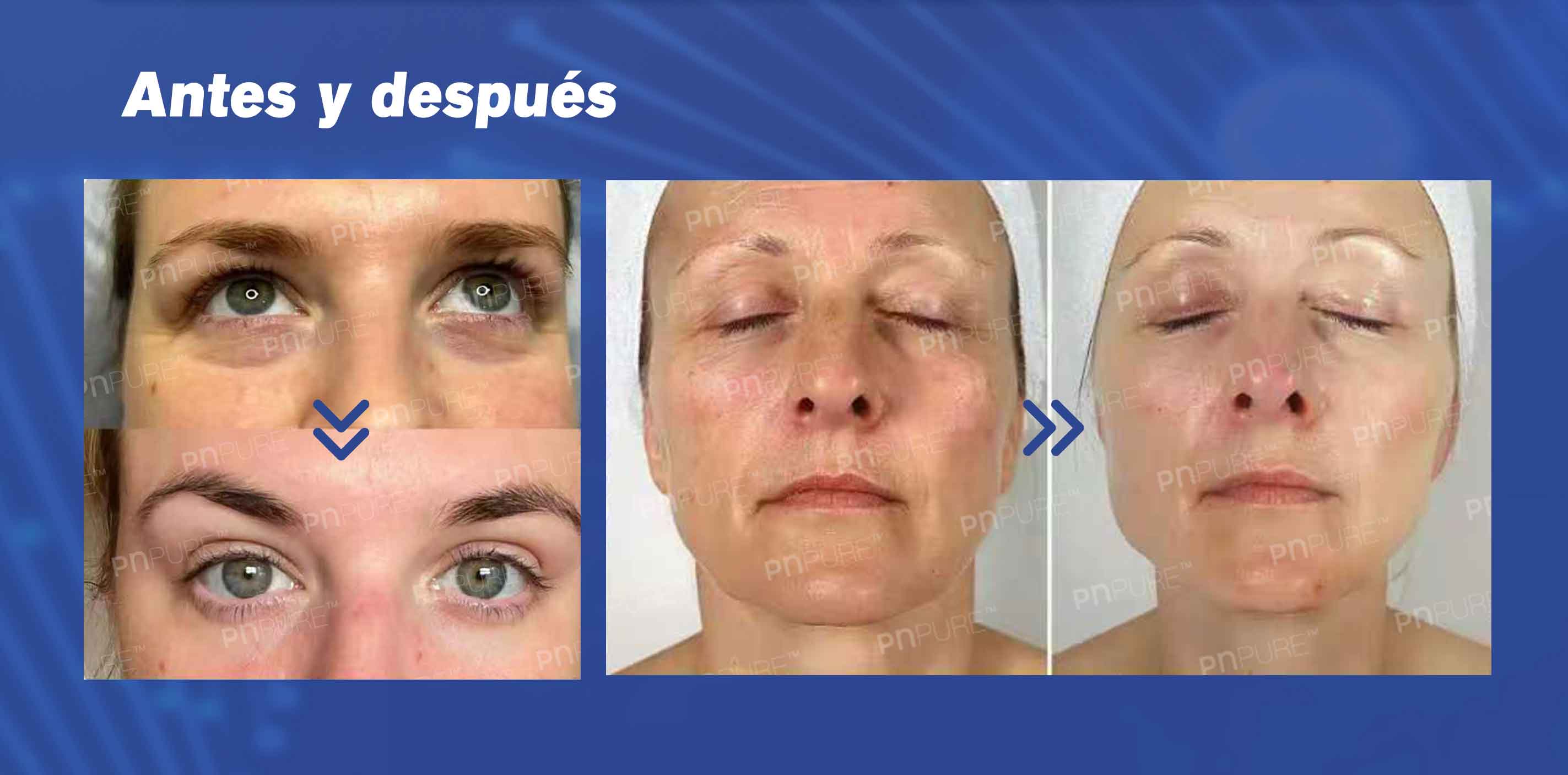 polinucle&oacute;tidos faciales