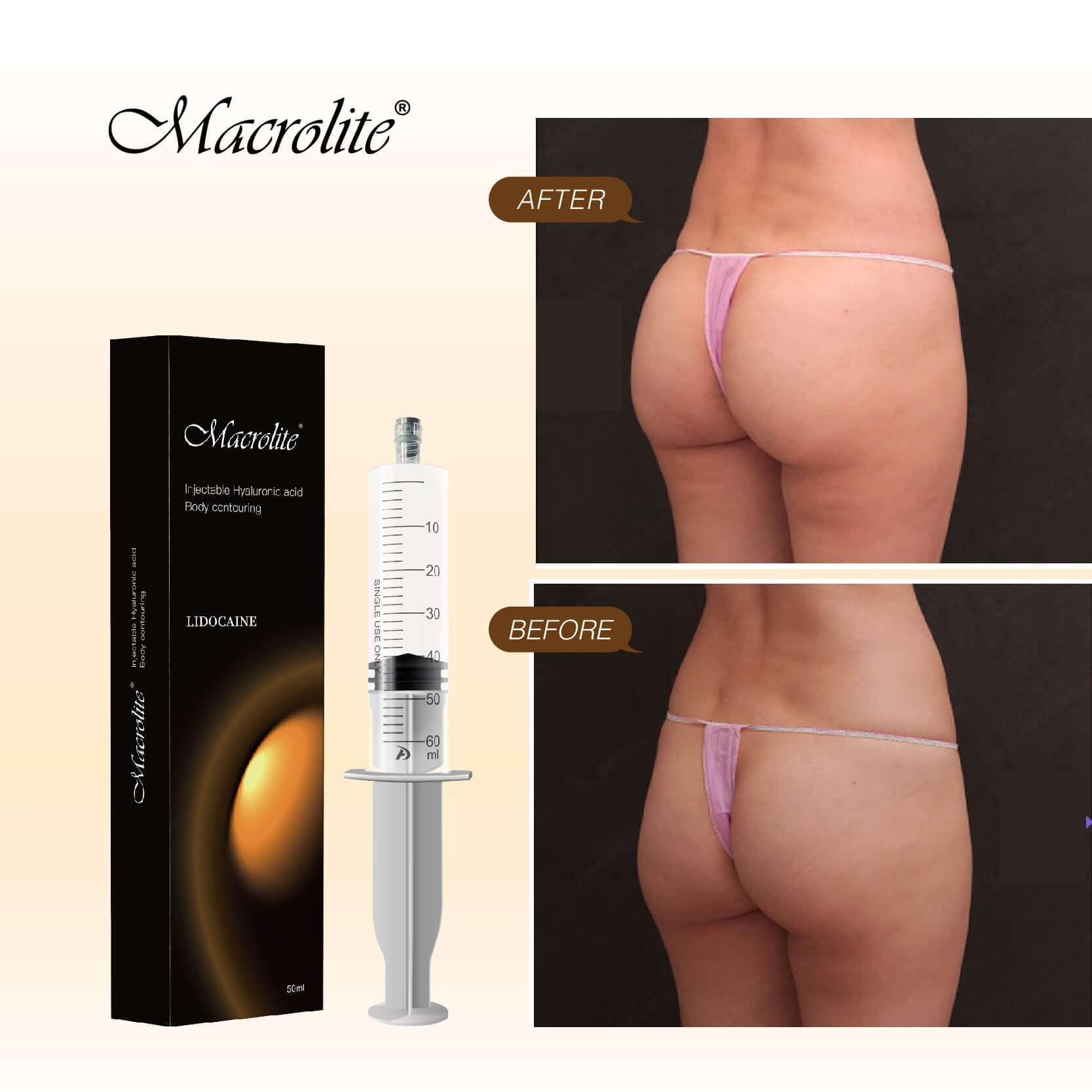 Rellenos De Acido Hialuronico En Gluteos Para Aumentar El Tamaño De Los Glúteos