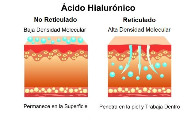 &aacute;cido hialuronico reticulado para gluteos