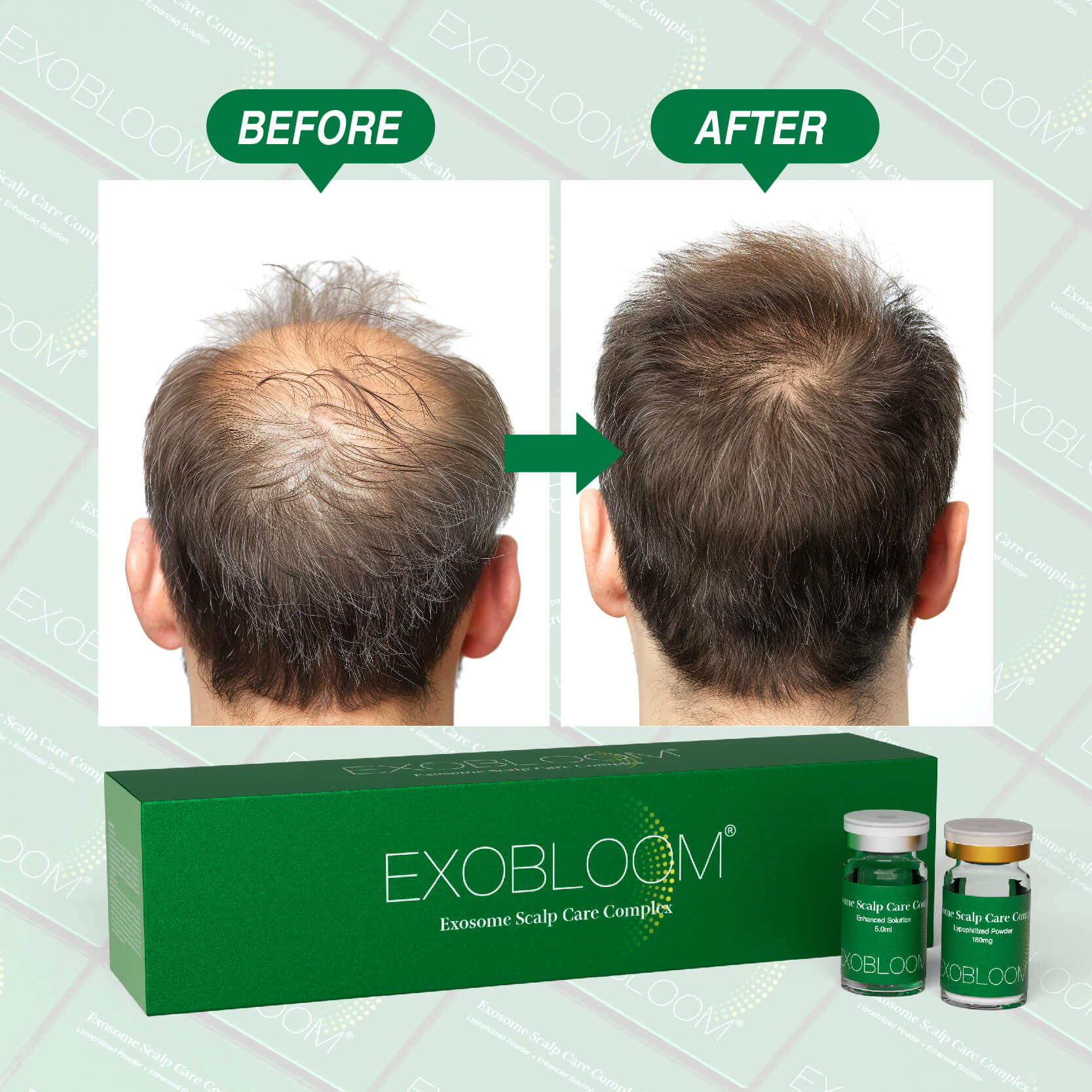 Alopecia Con Exosomas.jpg