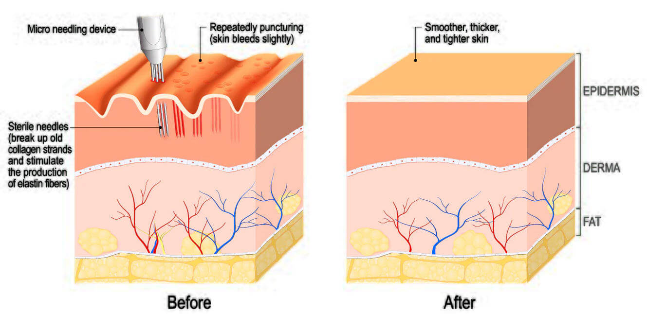 PDRN microneedling